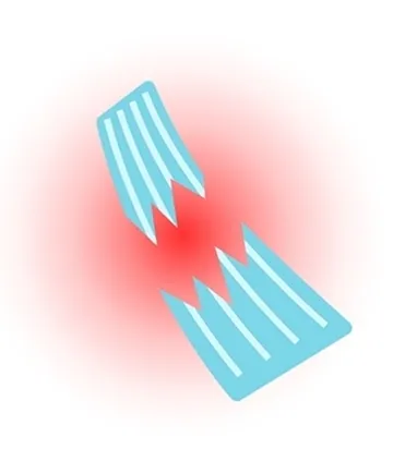 Nặng (Độ 3)