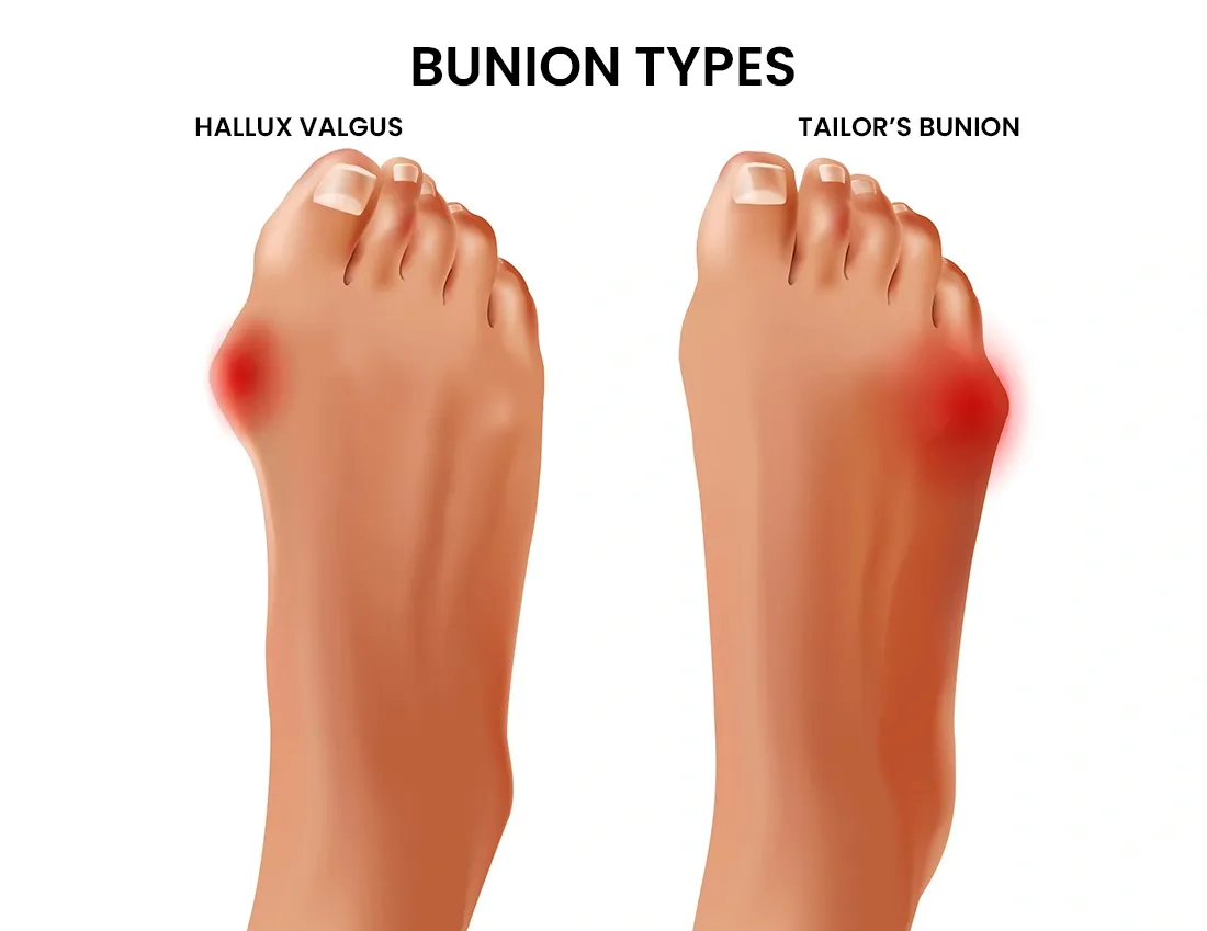 What Are the Types of Bunions?