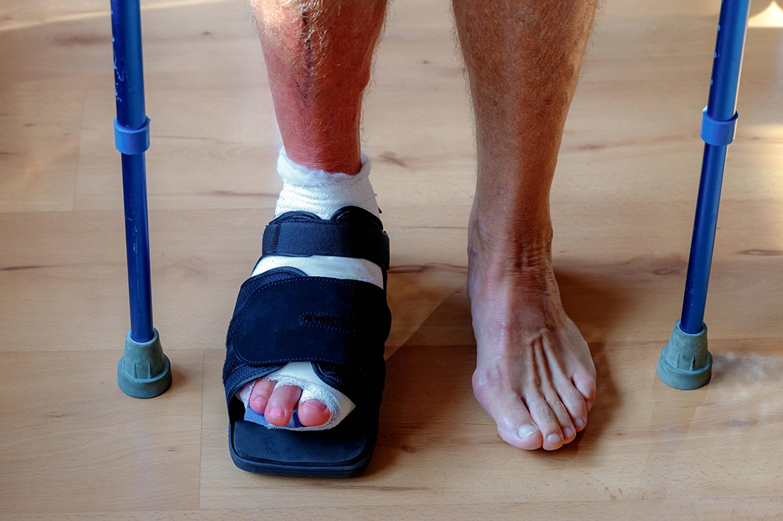 What to Expect After Bunion Surgery