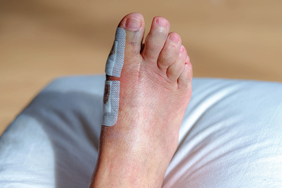How will my recovery after bunion surgery be?