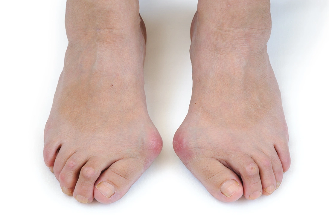 What Are the Possible Complications of Bunions?