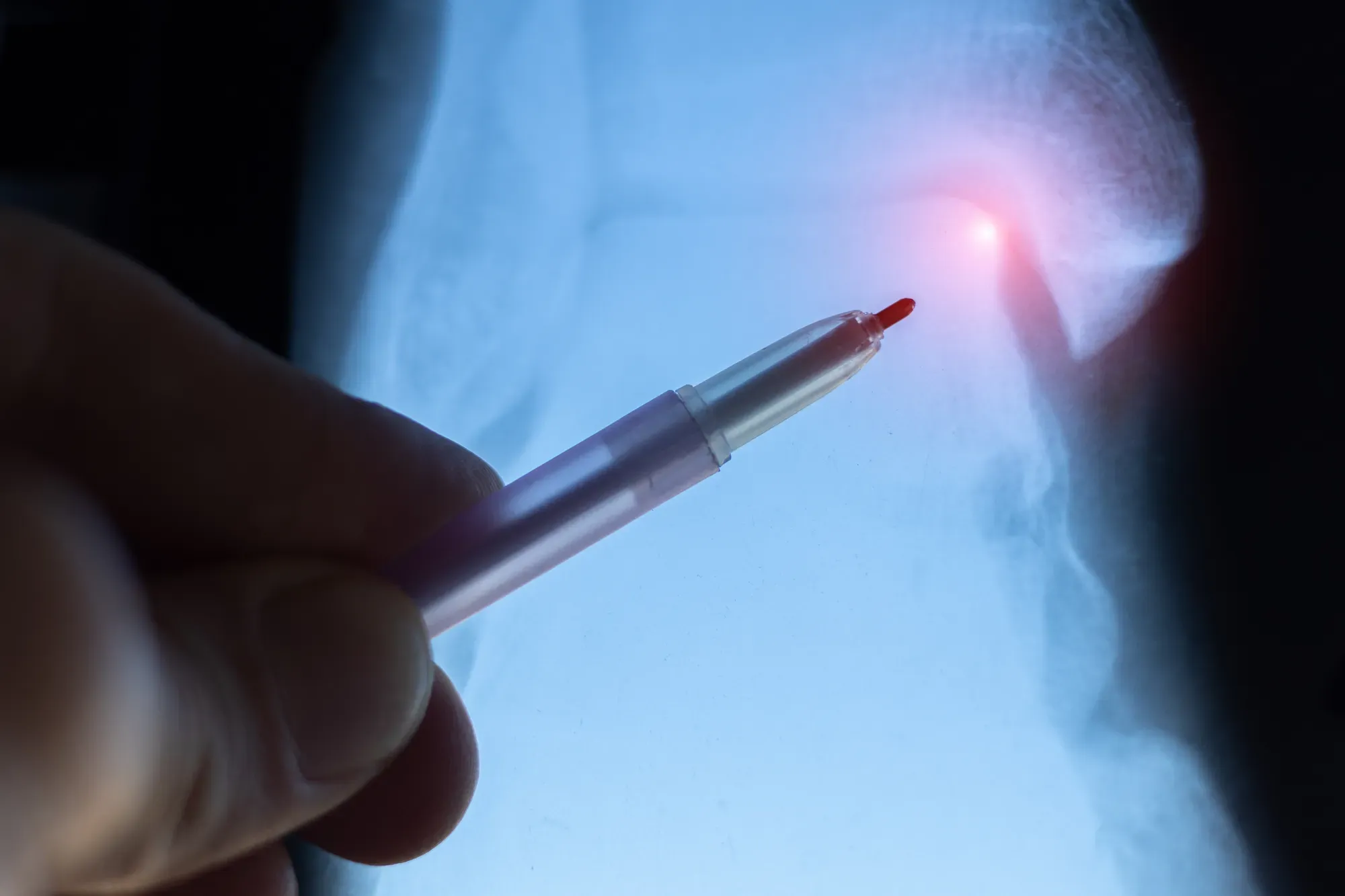 An X-ray showing a stress fracture (small crack) in a bone.