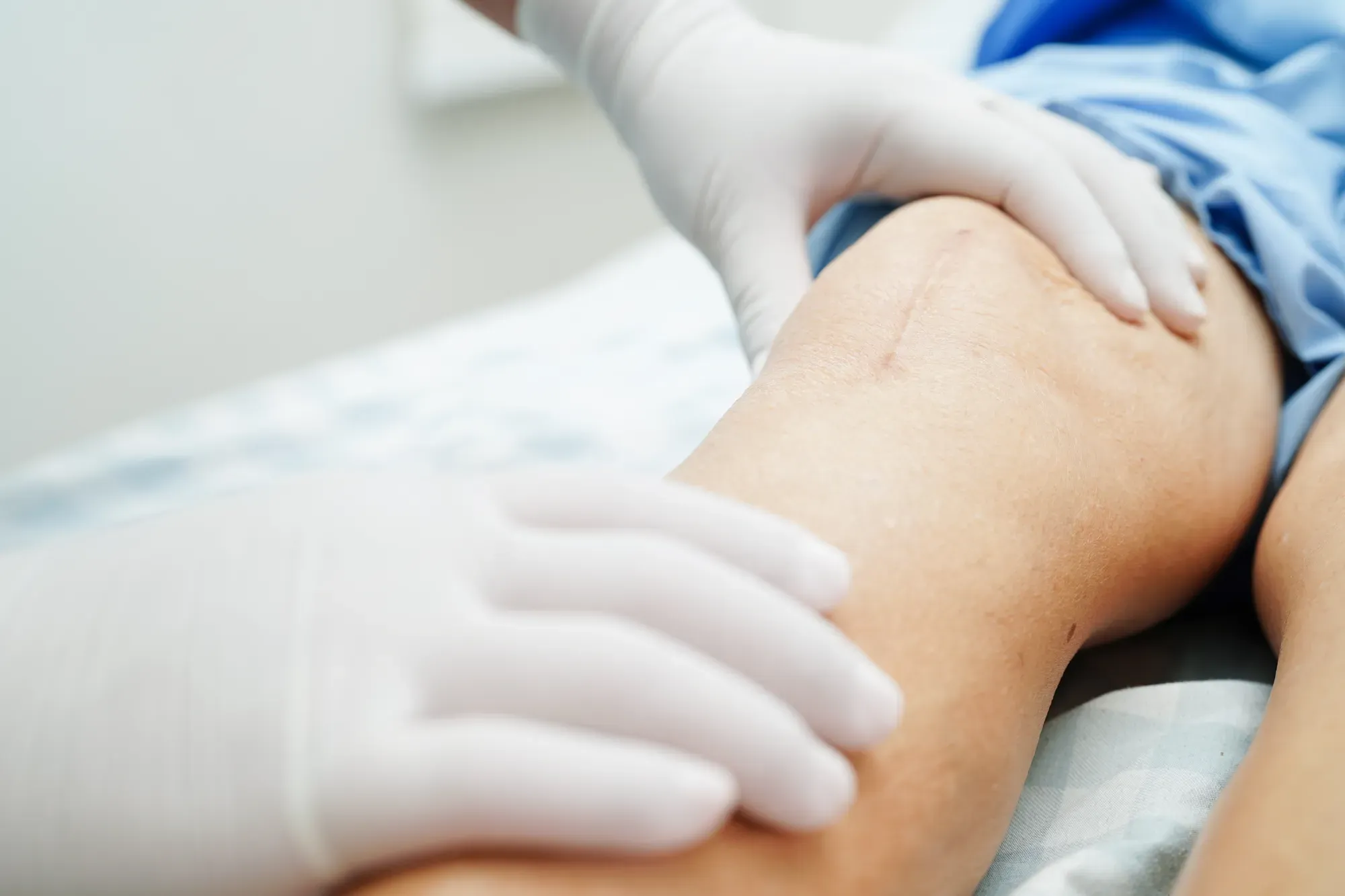 Close-up of a specialist assessing a patient's knee before knee replacement surgery.
