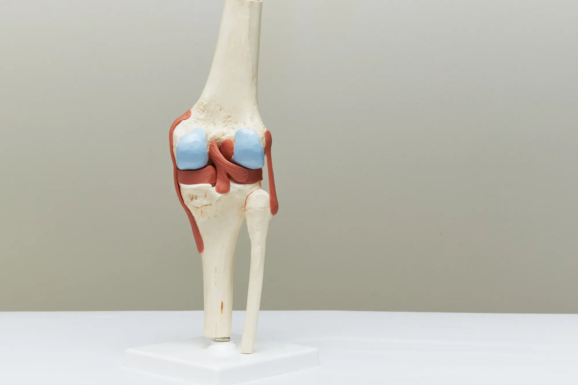A model of the human knee joint used for medical consultations on cartilage loss.