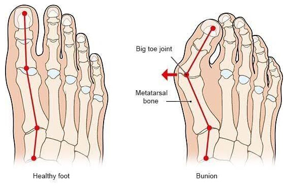 What is a Bunion