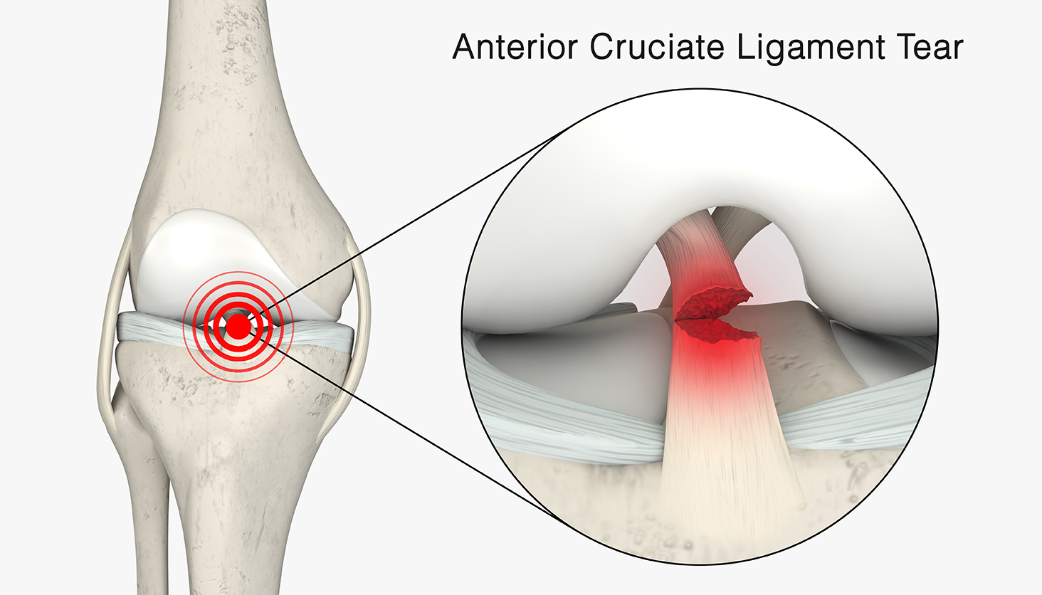 Five Ways to Prevent Anterior Cruciate Ligament Injuries