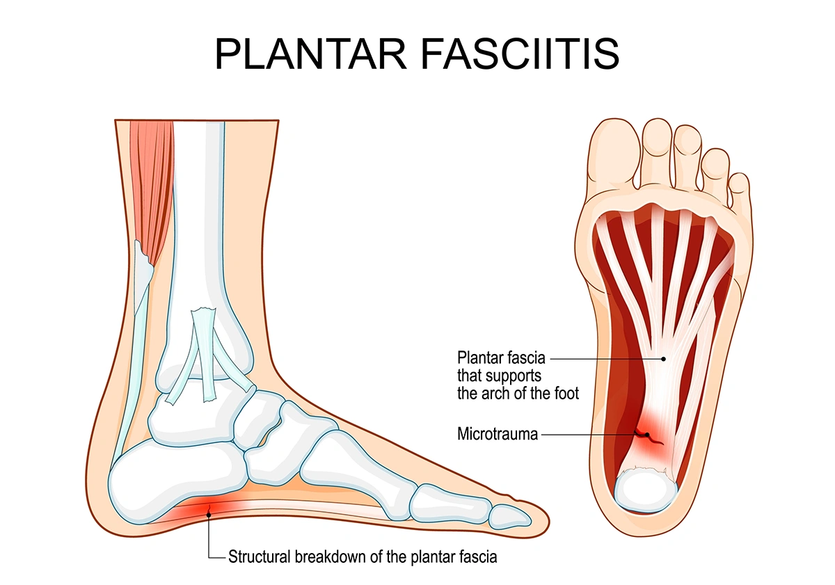A diagram explaining plantar fasciitis