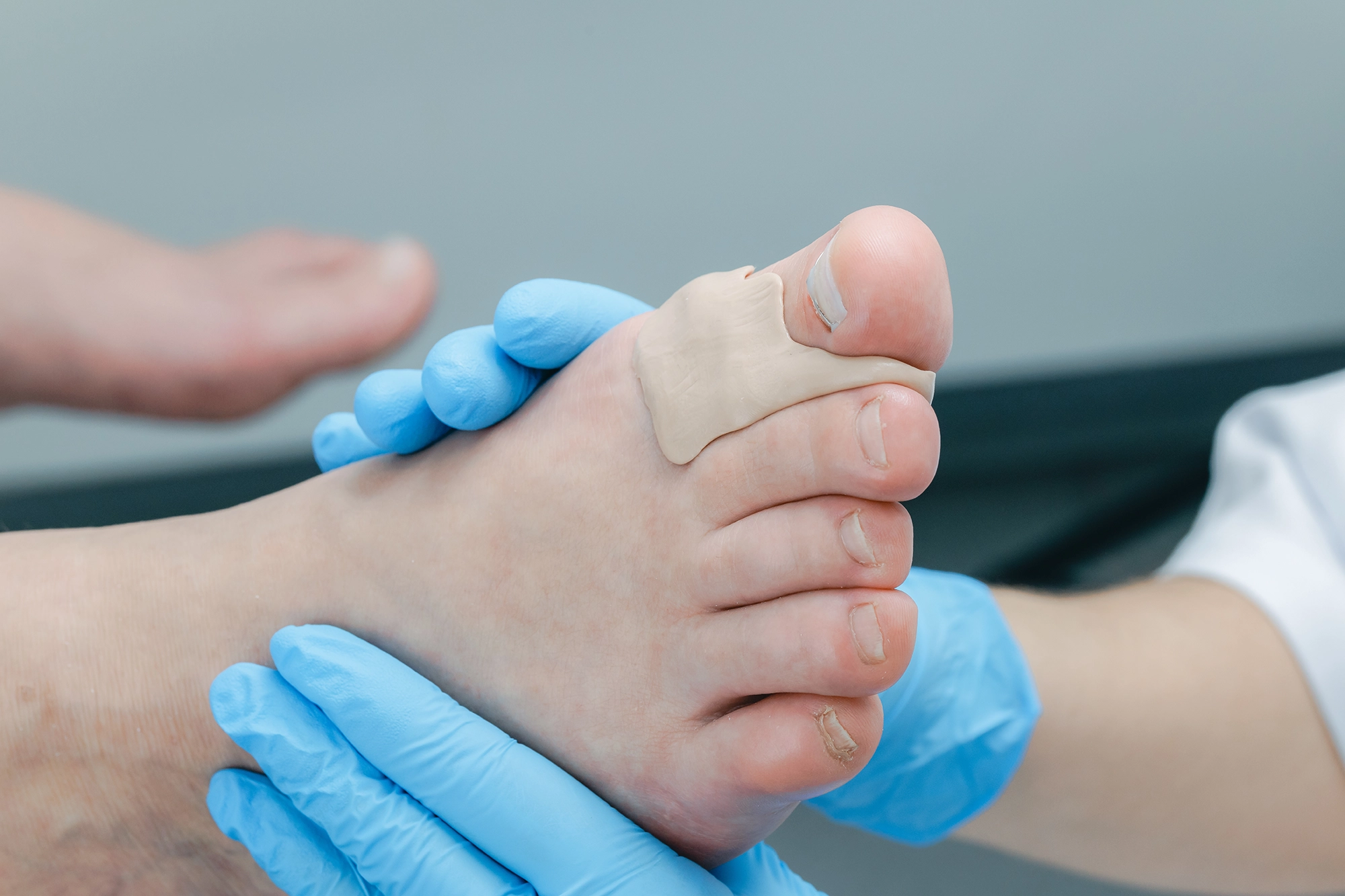 A medical professional assessing a patient's bunion condition