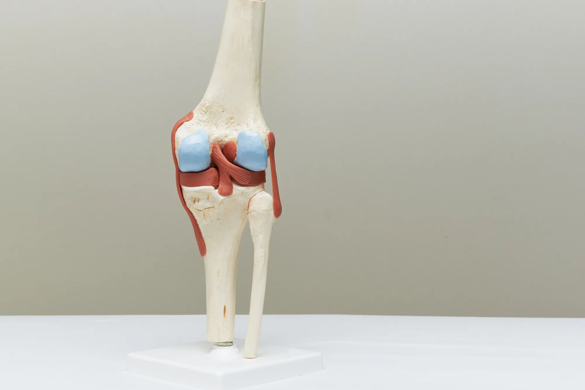 A model of the human knee joint used for medical consultations on cartilage loss.