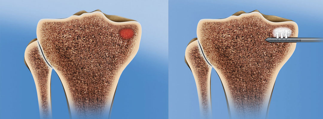 Subchondroplasty Treatment Singapore